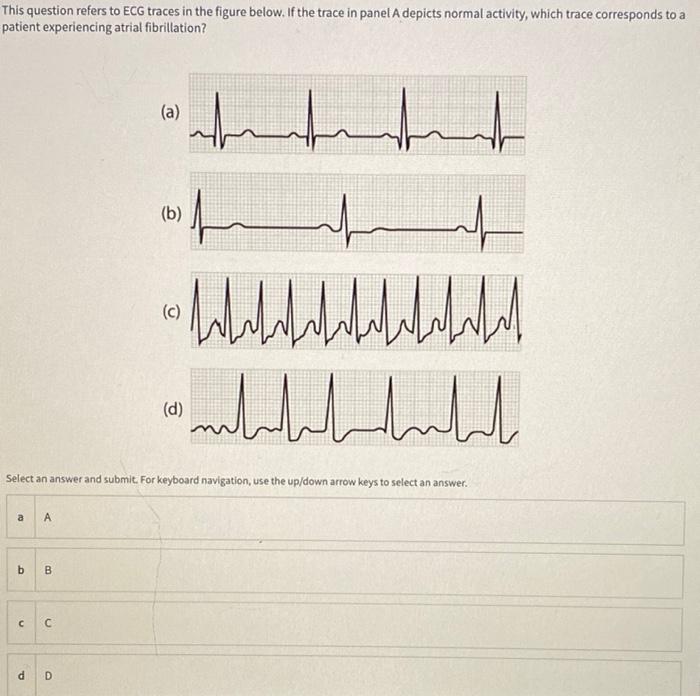 Solved This question refers to ECG traces in the figure | Chegg.com