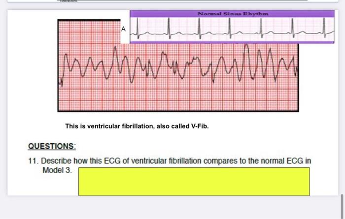 Solved ECGs are helpful in determining changes and | Chegg.com