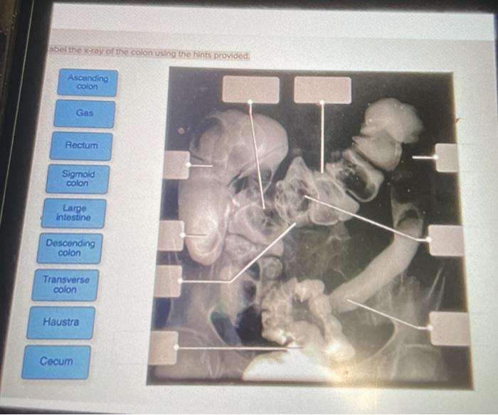 Solved bbel the xray of the colon using the hints provided