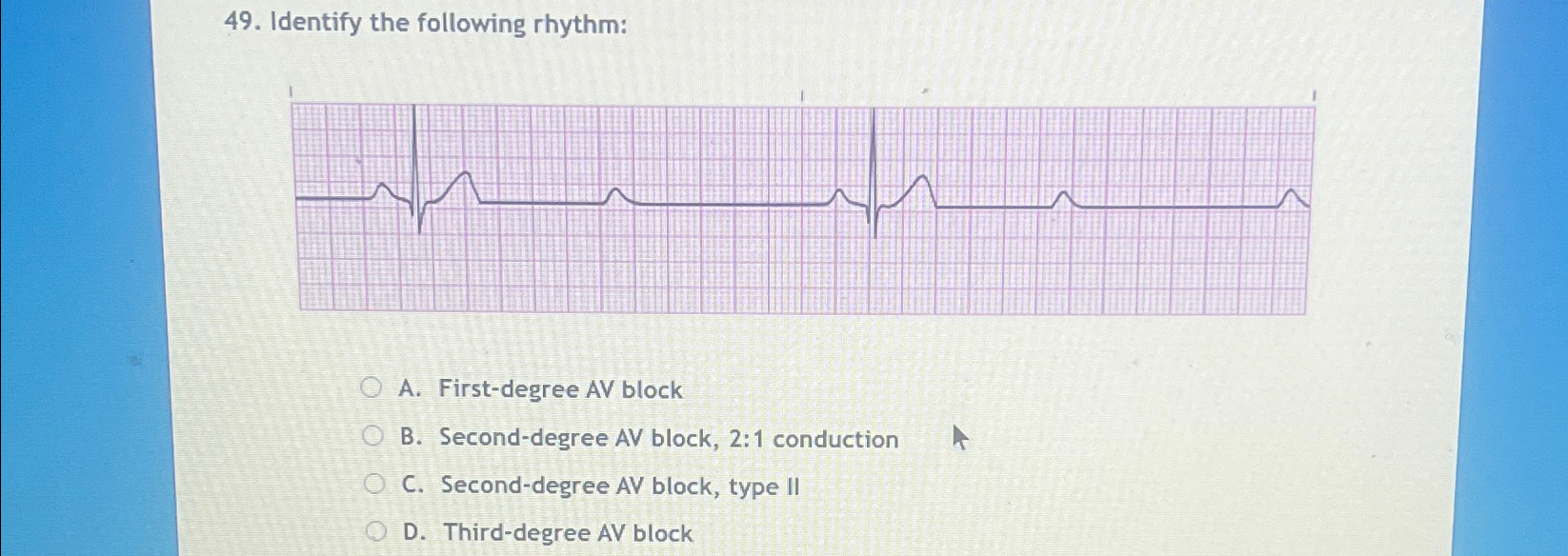 Solved Identify the following rhythm:A. ﻿First-degree AV | Chegg.com