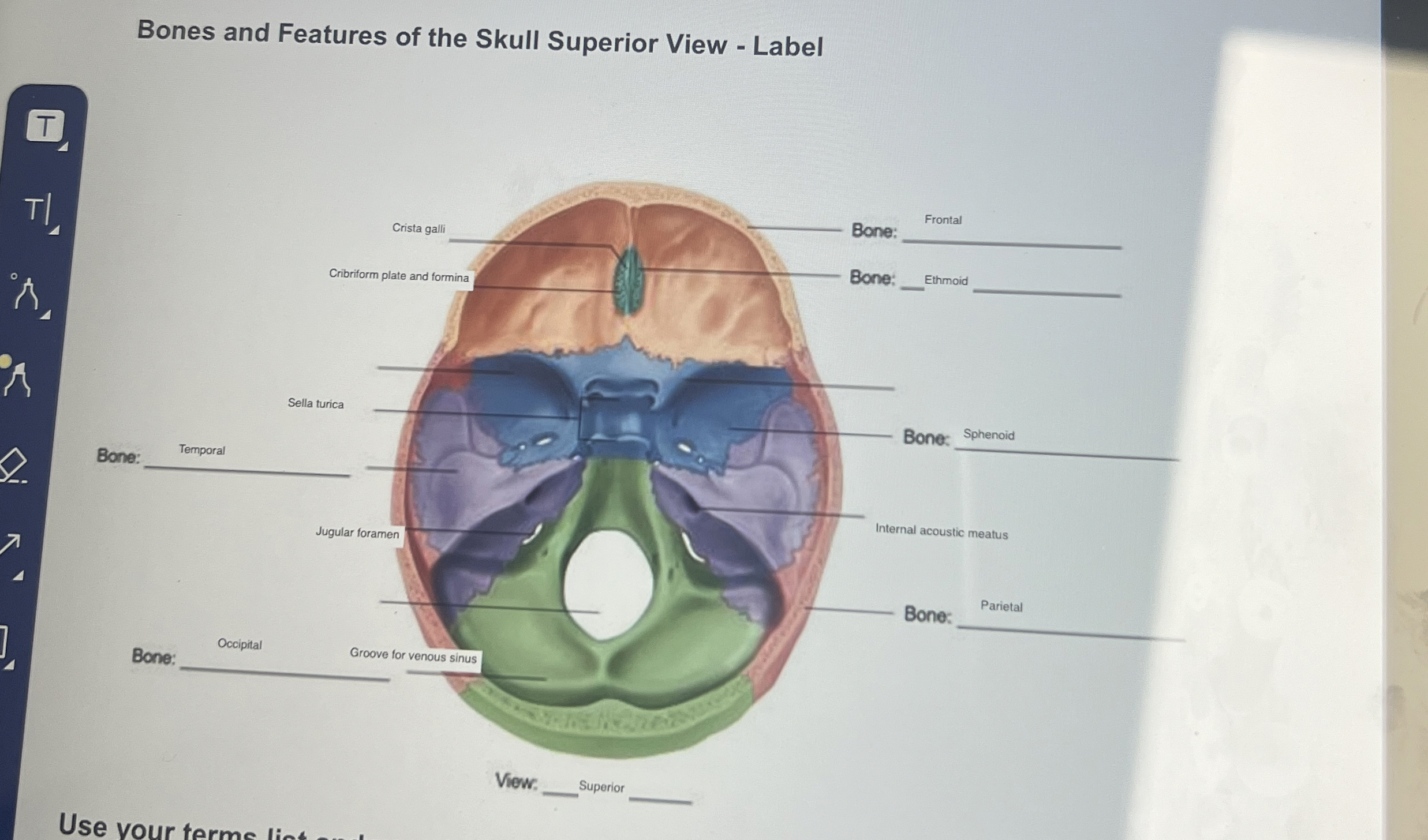 Solved Bones and Features of the Skull Superior View