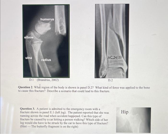 solved-question-1-what-kind-of-fracture-is-indicated-in-the-chegg