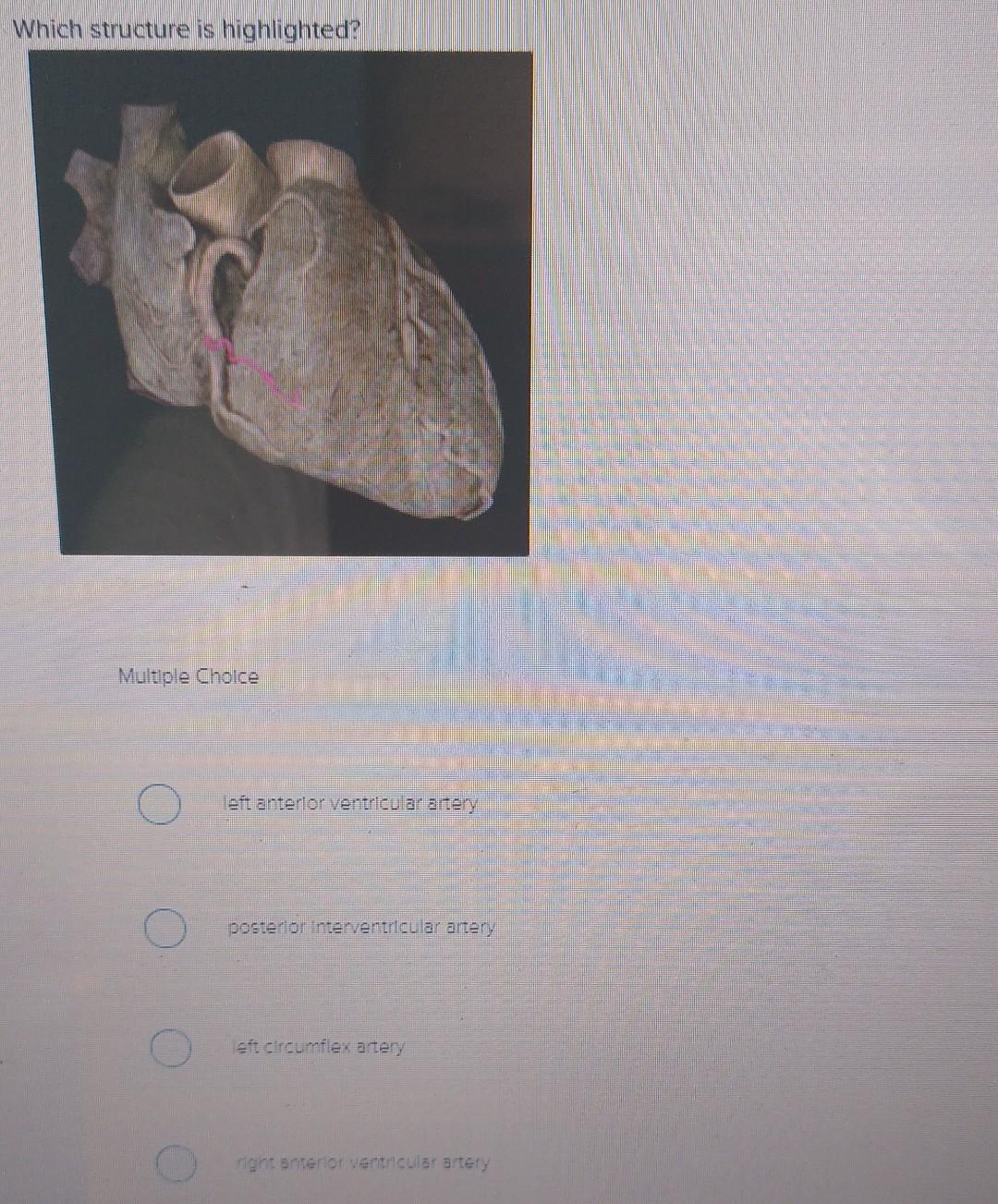 Which structure is highlighted? Multiple Choice left anterlor ventricular artery posterlor interventricular artery sit. clicu