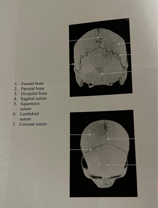 1. Frontal bone
2. Parietal bone
3. Occipital bone
4. Sagittal suture
5. Squamous suture
6. Lambdoid suture
7. Coronal suture