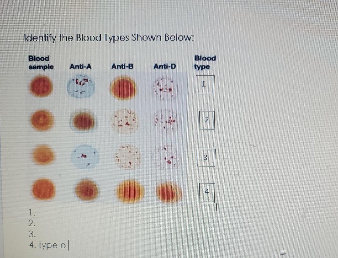 Solved Identify the Blood Types Shown Below: Blood sample | Chegg.com