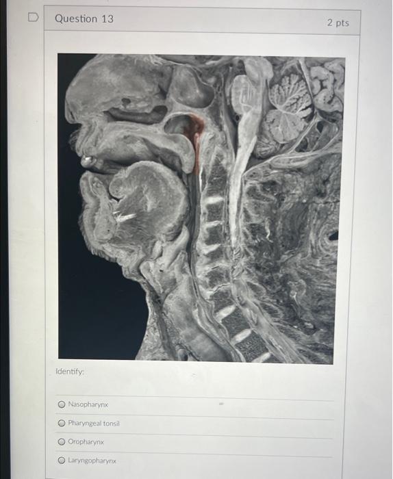 Solved Identify: Orópharynx Pharyngeal tonsil Nasopharynx | Chegg.com