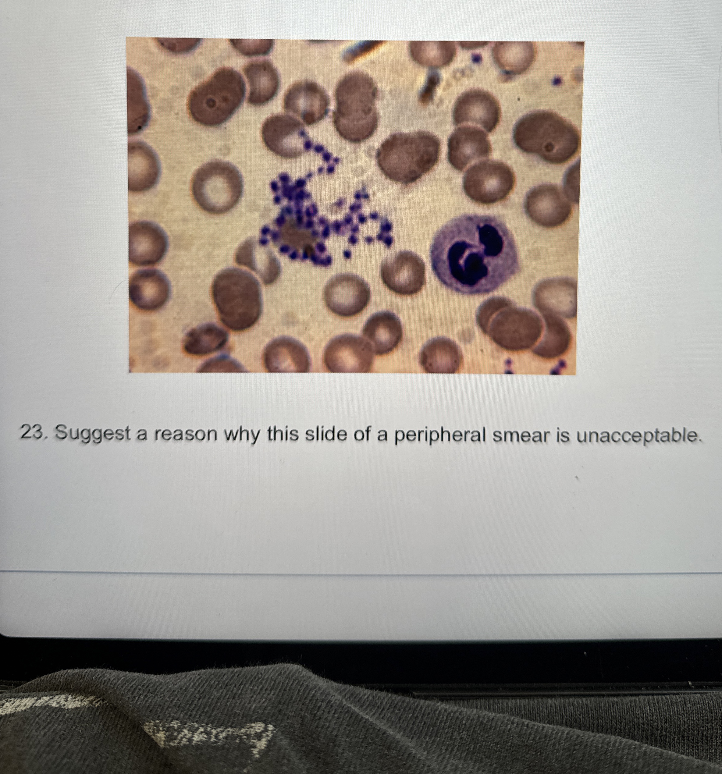 Solved Suggest a reason why this slide of a peripheral smear | Chegg.com