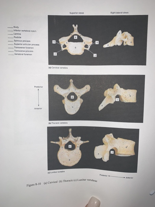 Solved (a) Atlas (C1) Posterior Body Dens Facet that | Chegg.com