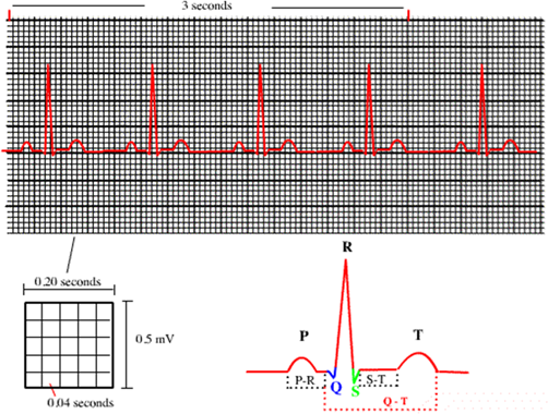 Normal qrs complex picture