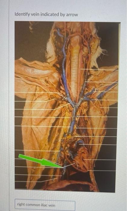 Solved Identify vein indicated by arrow Identify vein | Chegg.com