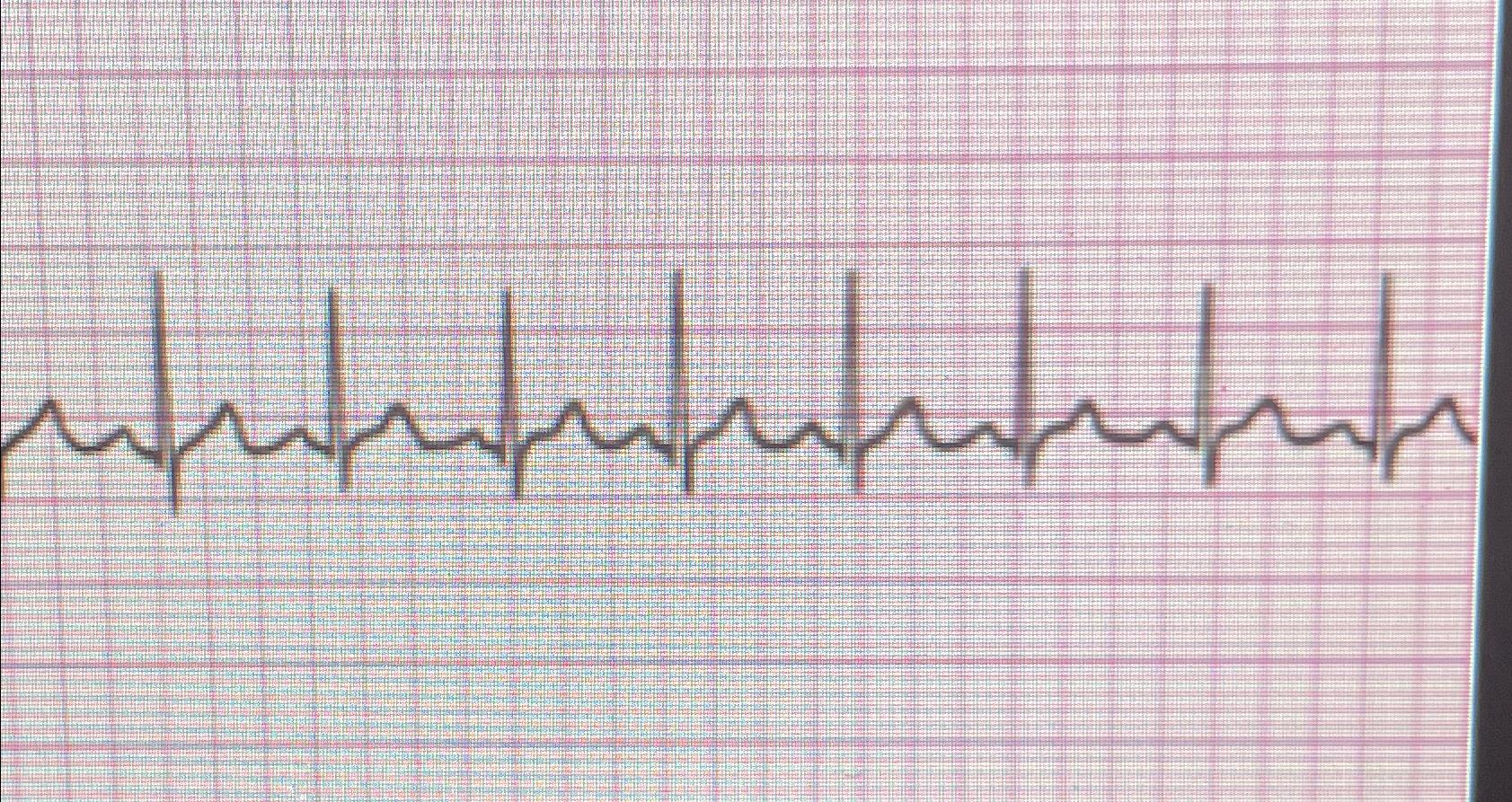 Solved What is the cardiac rhytm? | Chegg.com