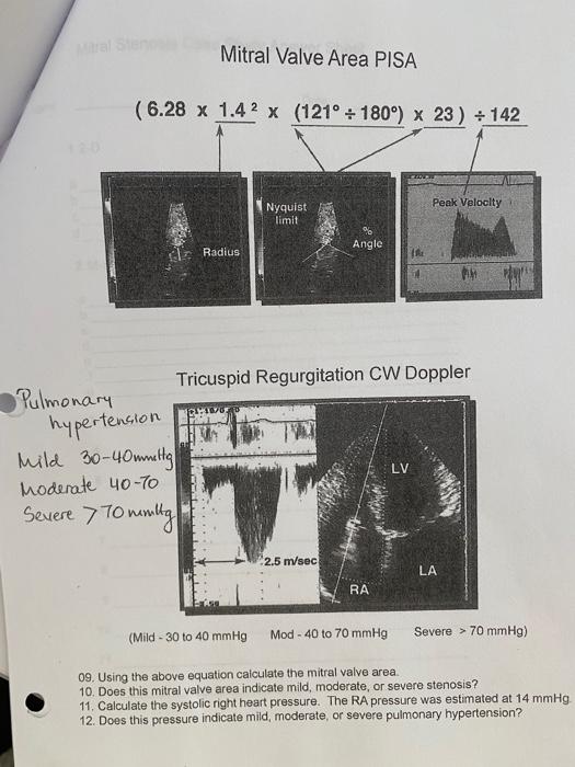 Mitral Valve Area PISA
Pulmonary Tricuspid Regurgitation CW Doppler hypertension
Mild \( 30-40 \) multi.
moderate \( 40-70 \)