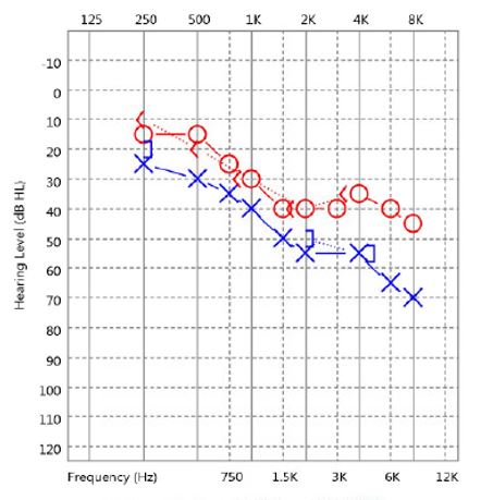 Solved How would you describe the audiogram results to the | Chegg.com