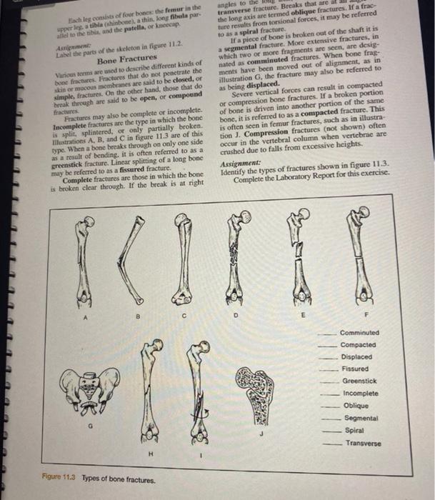 linear bone fracture