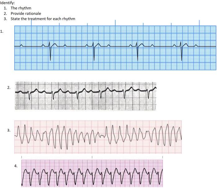 Solved Identify: 1. The rhythm 2. Provide rationale 3. State | Chegg.com