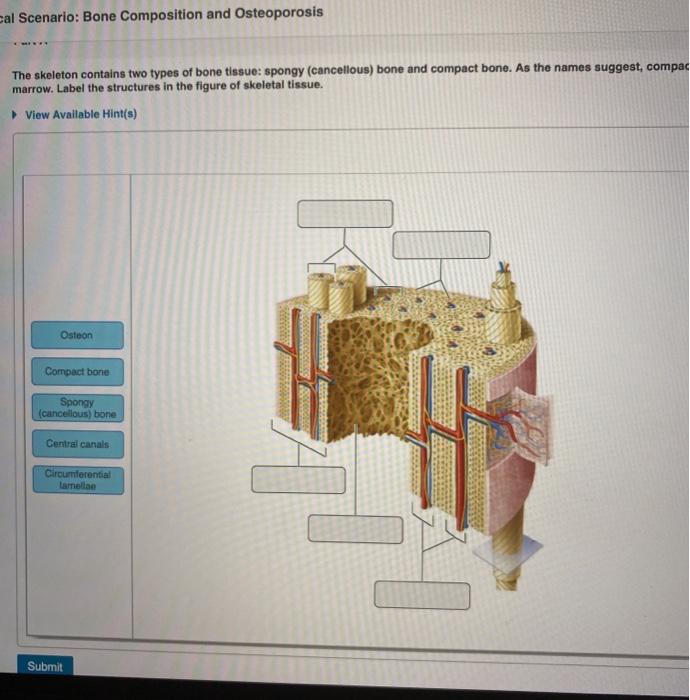 Solved cal Scenario: Bone Composition and Osteoporosis The | Chegg.com