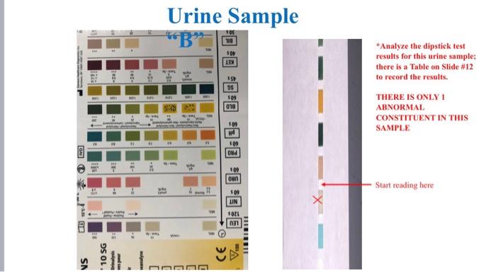 Urine Sample Sob 12 55 OS 509 018 *Analyze the dipstick test results for this urine sample: there is a Table on Slide #12 to