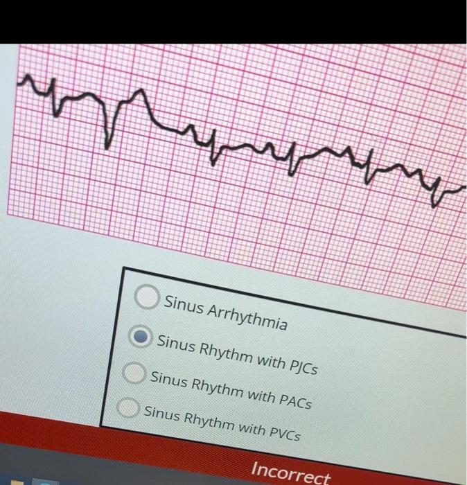 Solved Junctional Tachycardia Supraventricular Tachycardia | Chegg.com