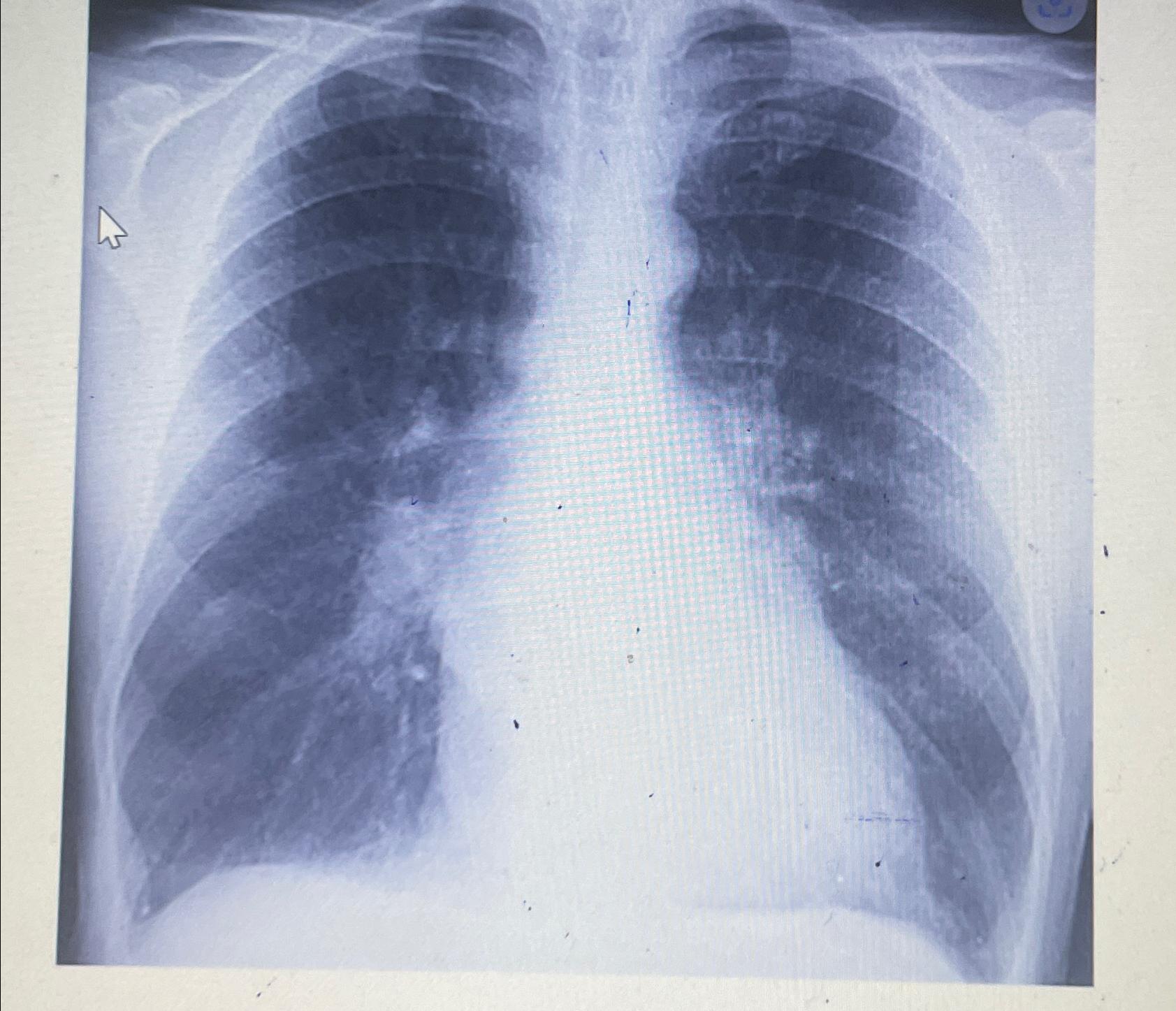 Solved A 65-year-old lady has had dyspnea and an increasing | Chegg.com