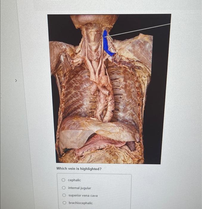 Which vein is highlighted?
cephalic
internal jugular
superior vena cava
brachiocephalic