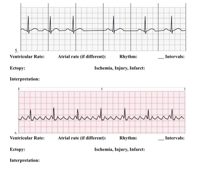 5. Ventricular Rate: Ectopy: Ischemia, Injury, | Chegg.com | Chegg.com