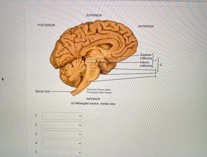 Solved SUPERIOR POSTERIOR ANTERIOR Superior colliculus | Chegg.com