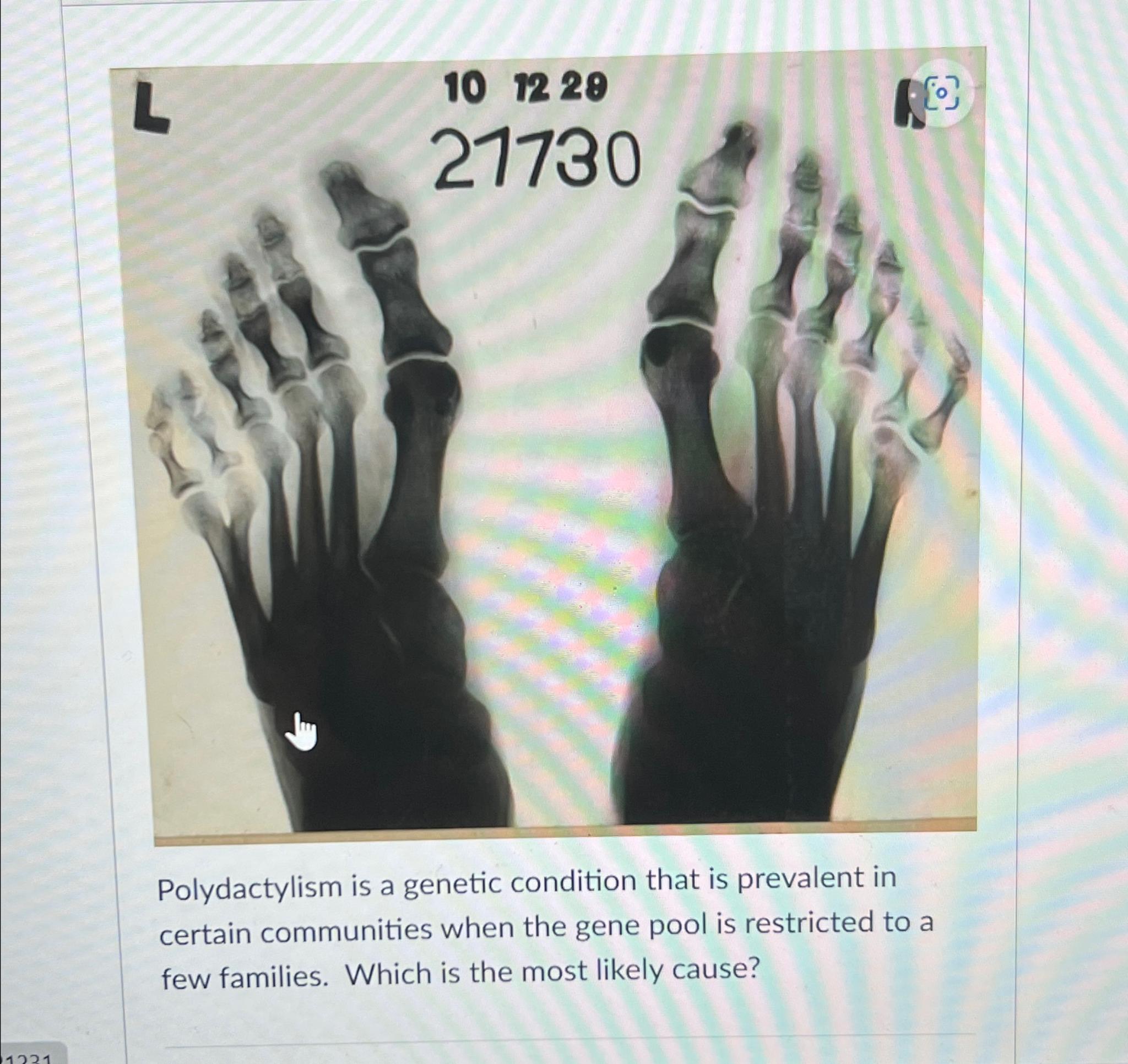 Solved Polydactylism is a genetic condition that is | Chegg.com