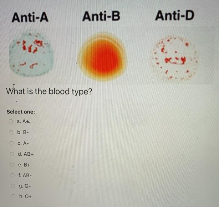 Solved Anti A Anti B Anti D What Is The Blood Type Selec Chegg Com