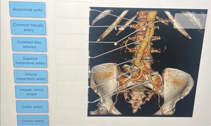 Solved abdominal aorta and iliac arteries CTA 1label the | Chegg.com