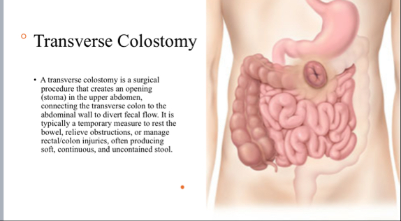 Solved Transverse ColostomyA transverse colostomy is a | Chegg.com